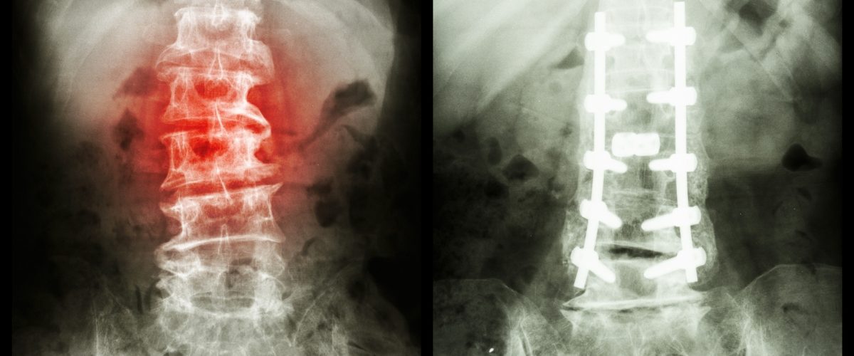Cirurgia de espondilolistese