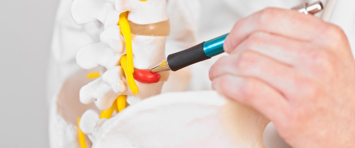 médico apontando uma hérnia de disco